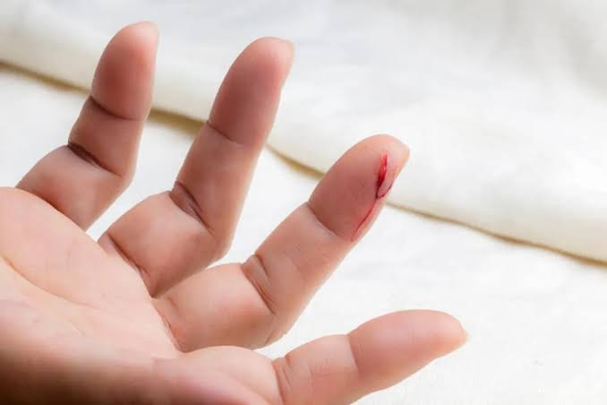 Kerusakan Jaringan Tubuh Atau Luka Akibat Banyak Hal